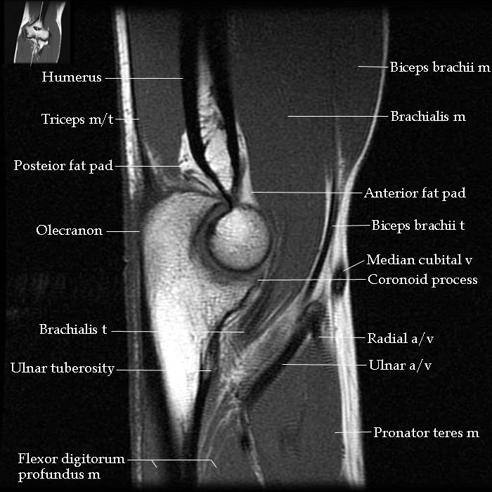 Elbow Mri Anatomy Elbow Imaging In Sport Sports Imaging Series