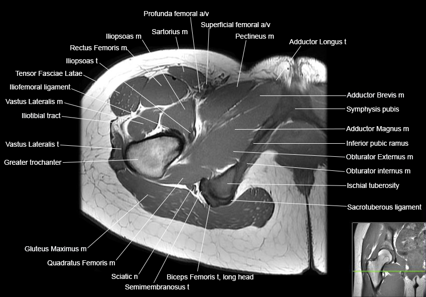 Pectineus Muscle Axial