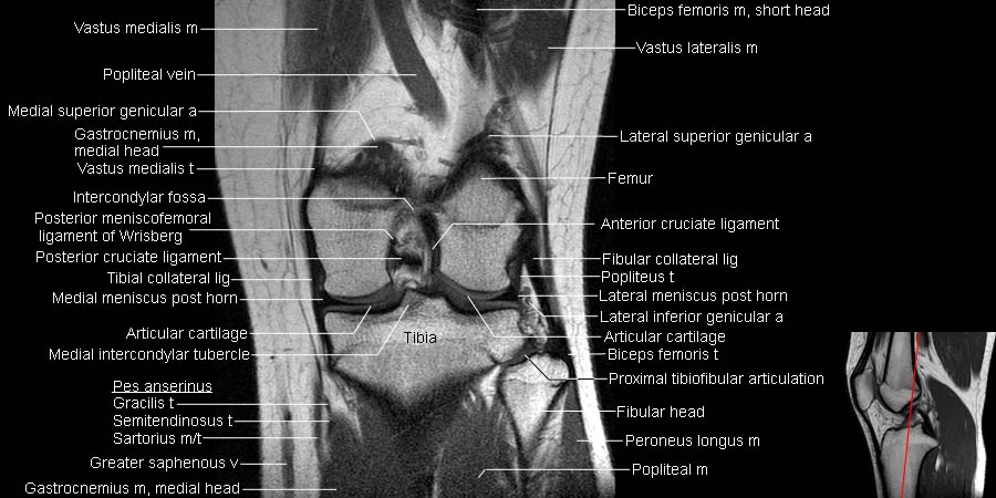 Knee Muscle Anatomy Mri Atlas Of Knee Mri Anatomy Wradiology 1280x660